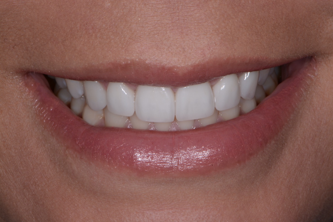 Case 1 after photo 1