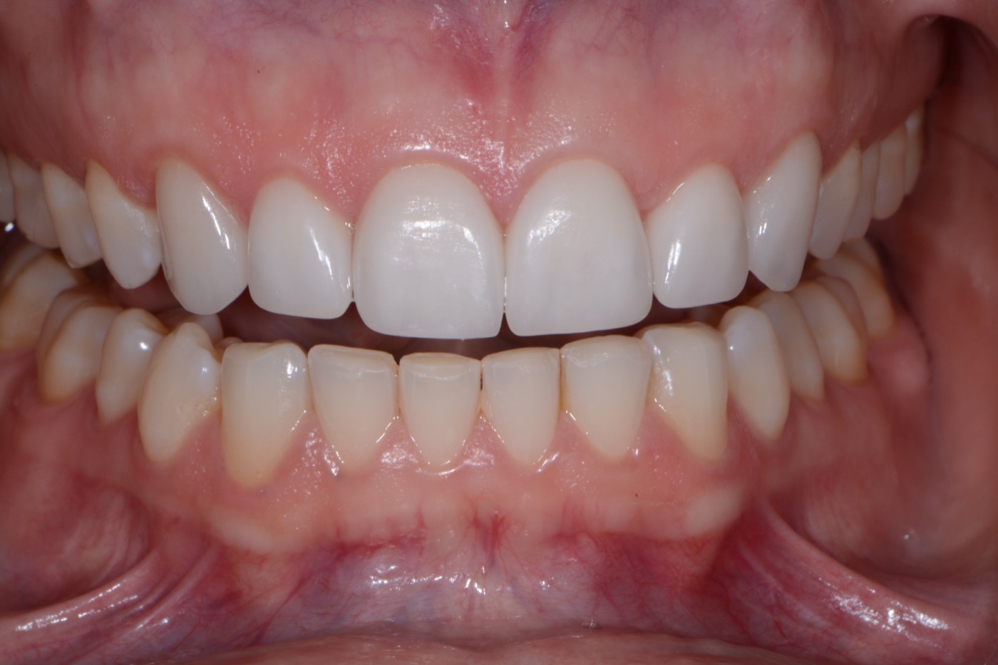 Case 1 after photo 2
