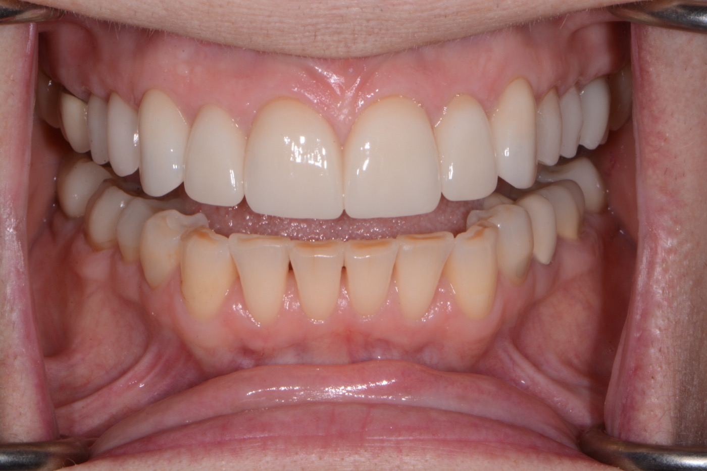 Case 3 after photo 2
