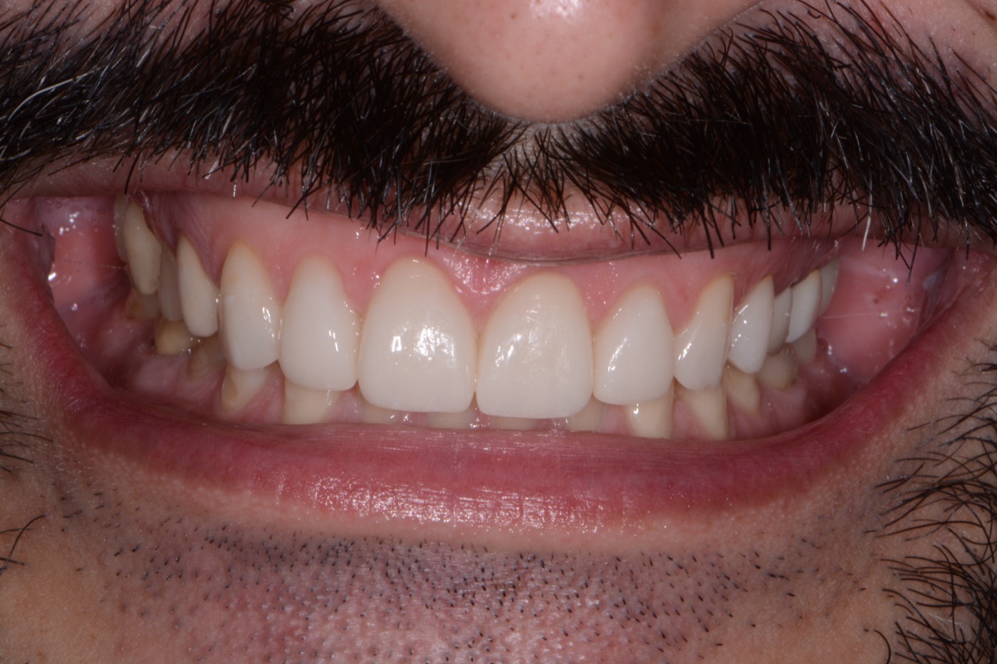 Case 5 after photo 1