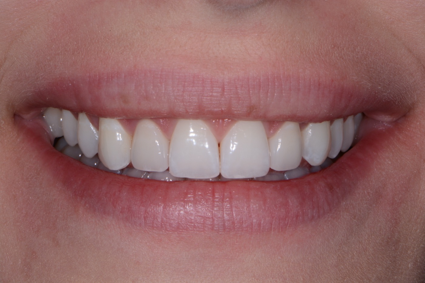 Case 6 after photo 1