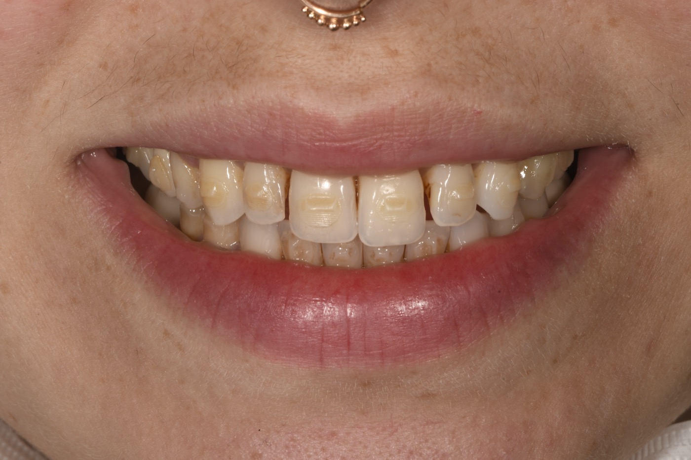Case 7 before photo 1