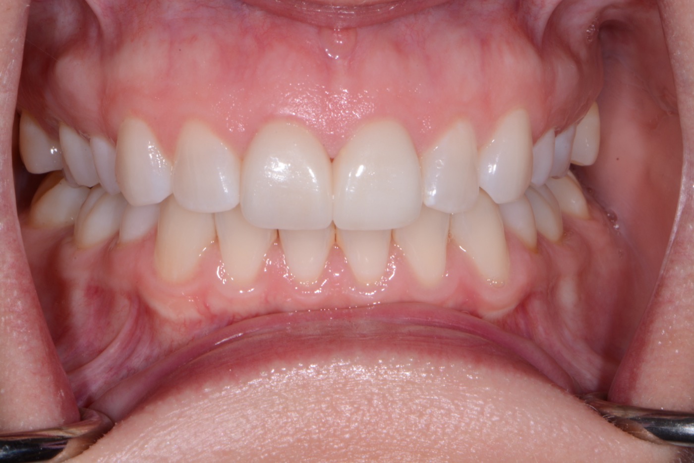 Case 9 after photo 2