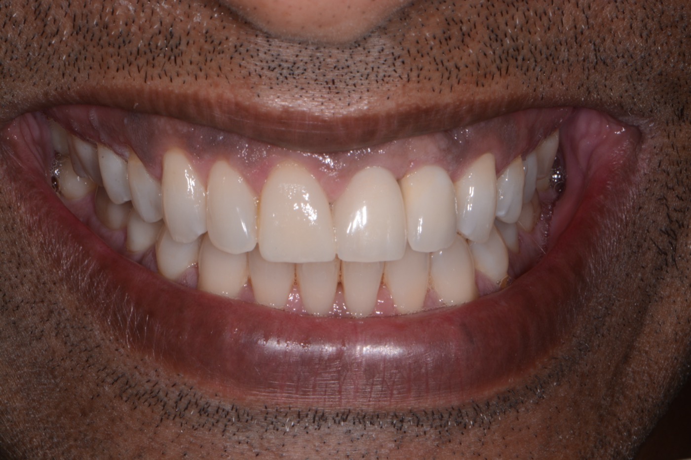 Case 10 after photo 1