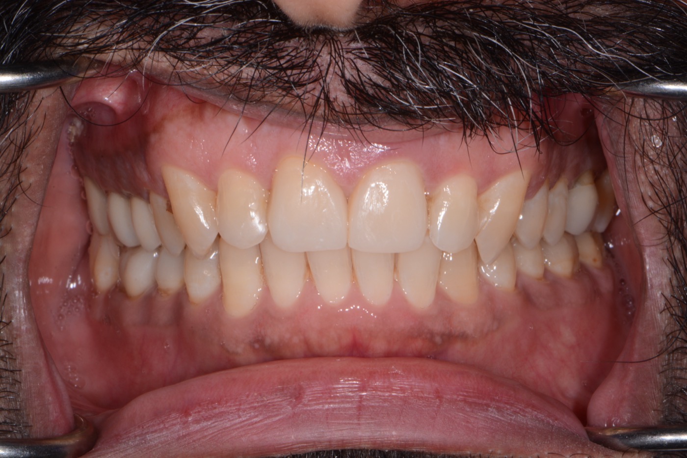 Case 11 after photo 2