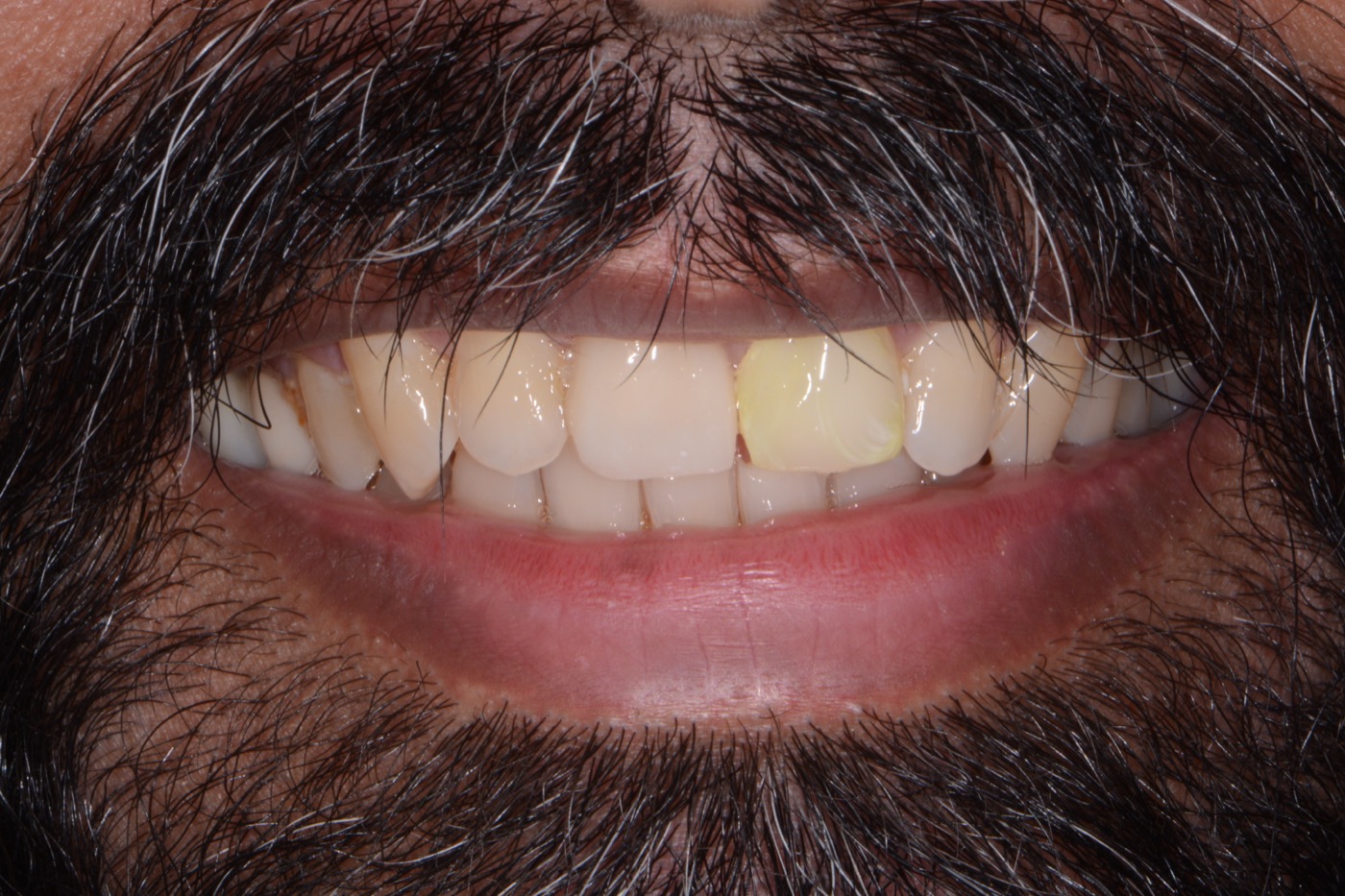 Case 11 before photo 1
