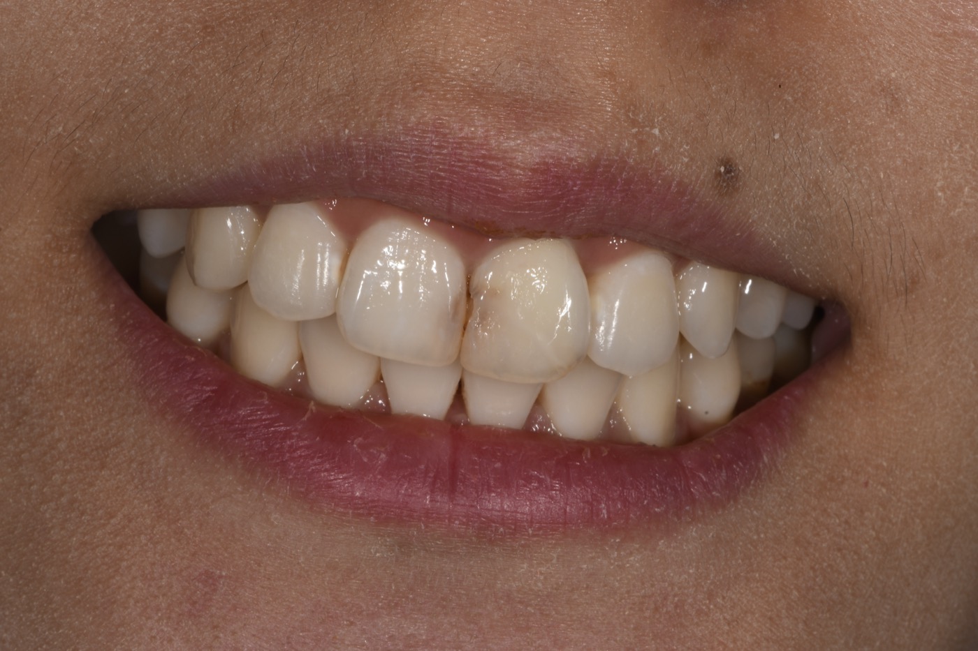 Case 12 before photo 1