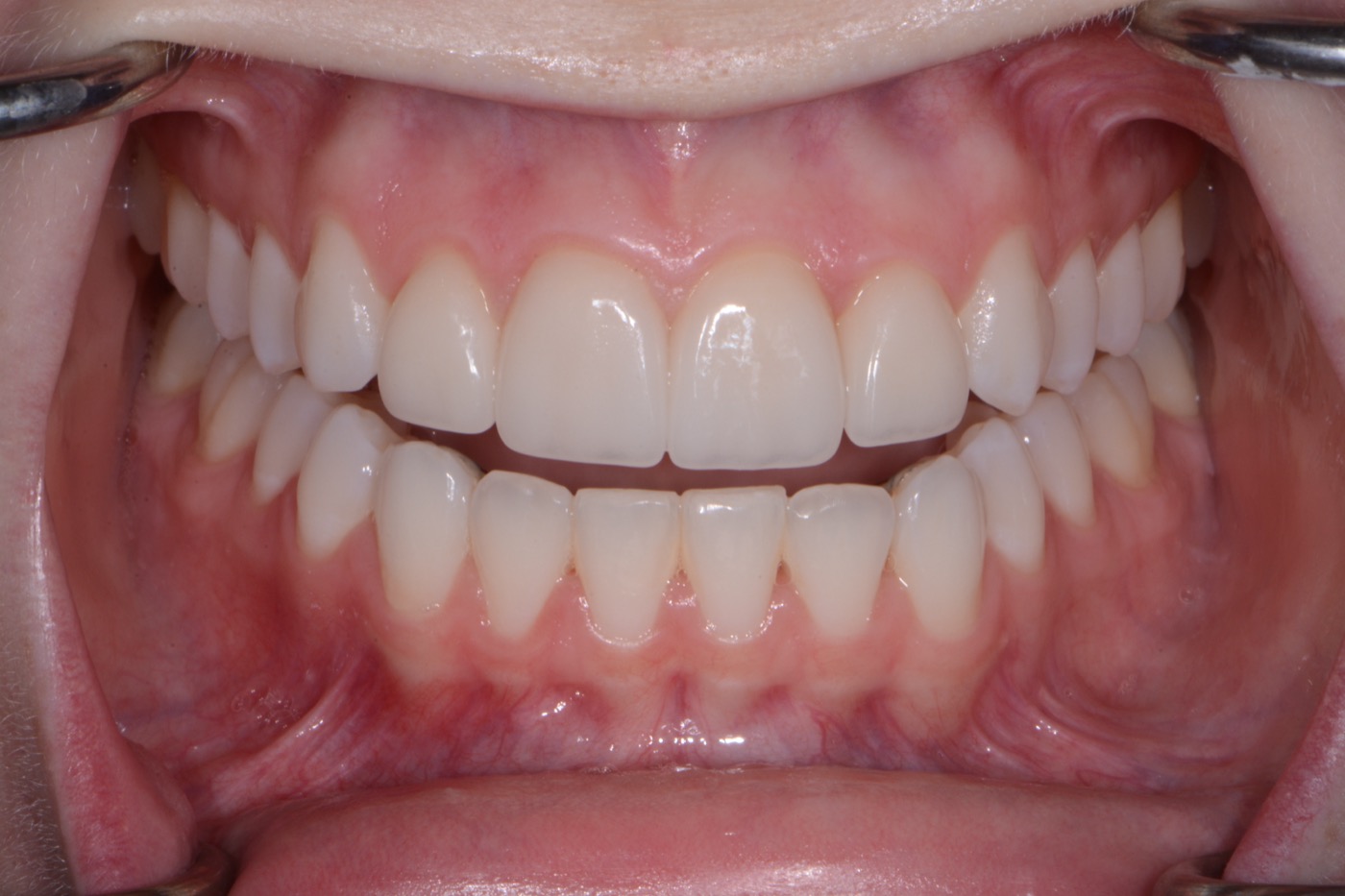 Case 13 after photo 2