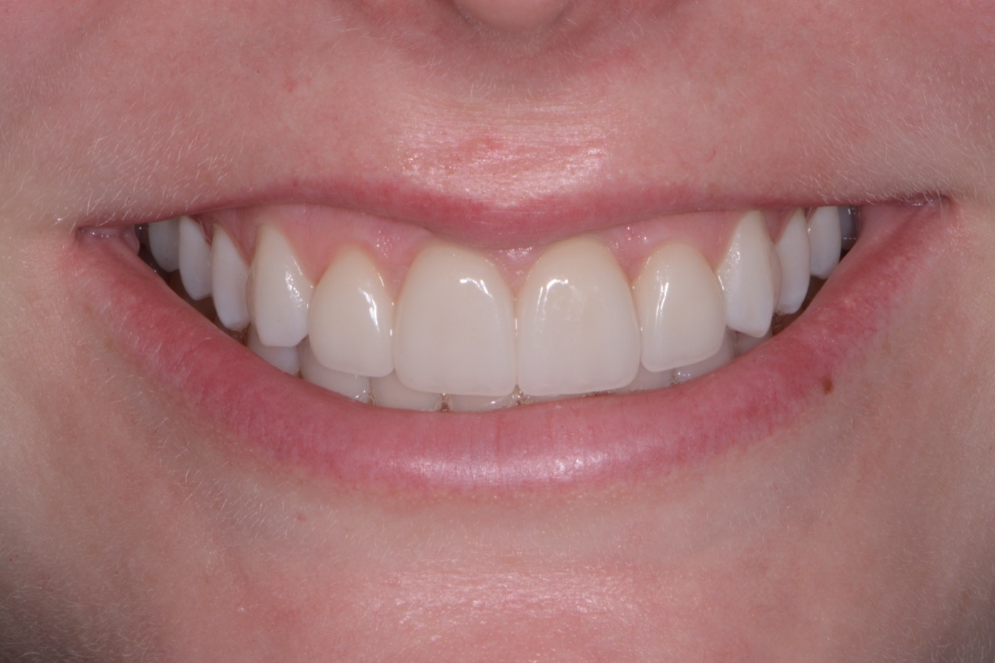 Case 13 after photo 1