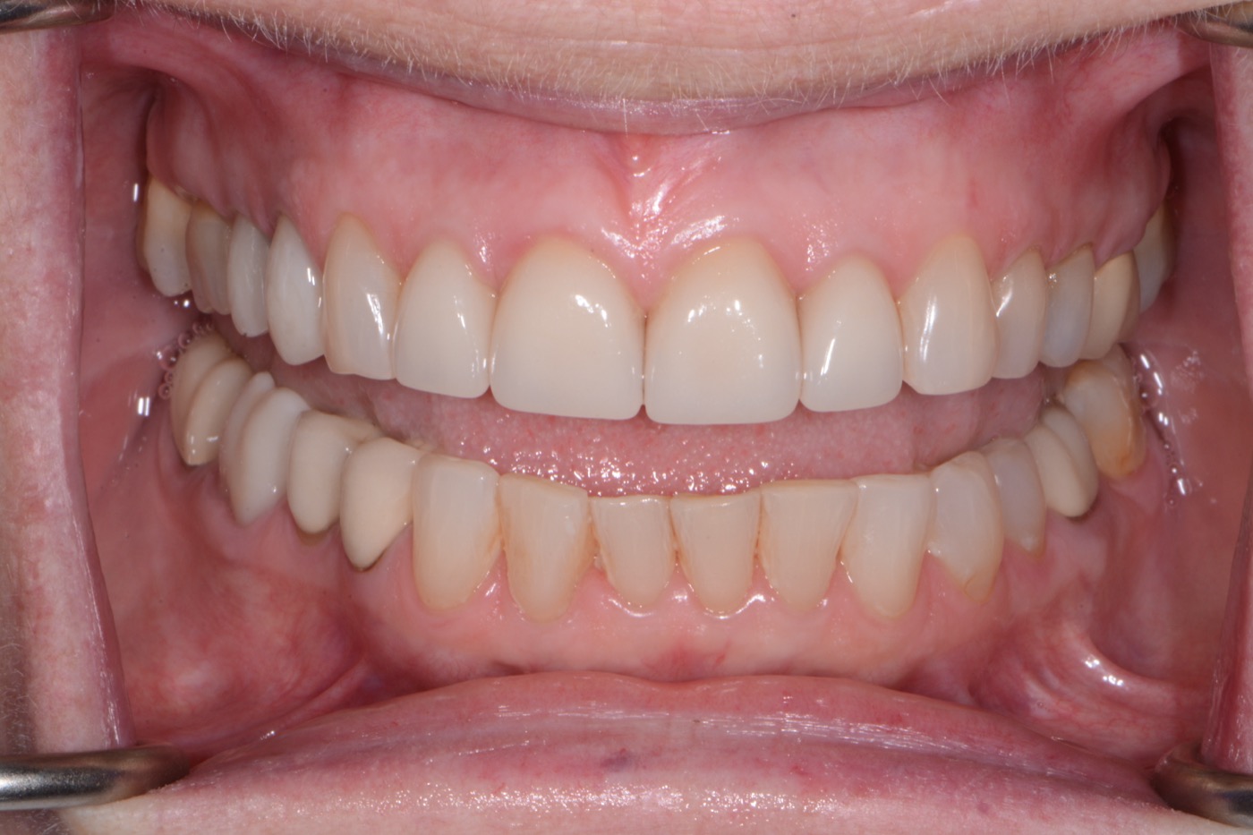 Case 14 after photo 2