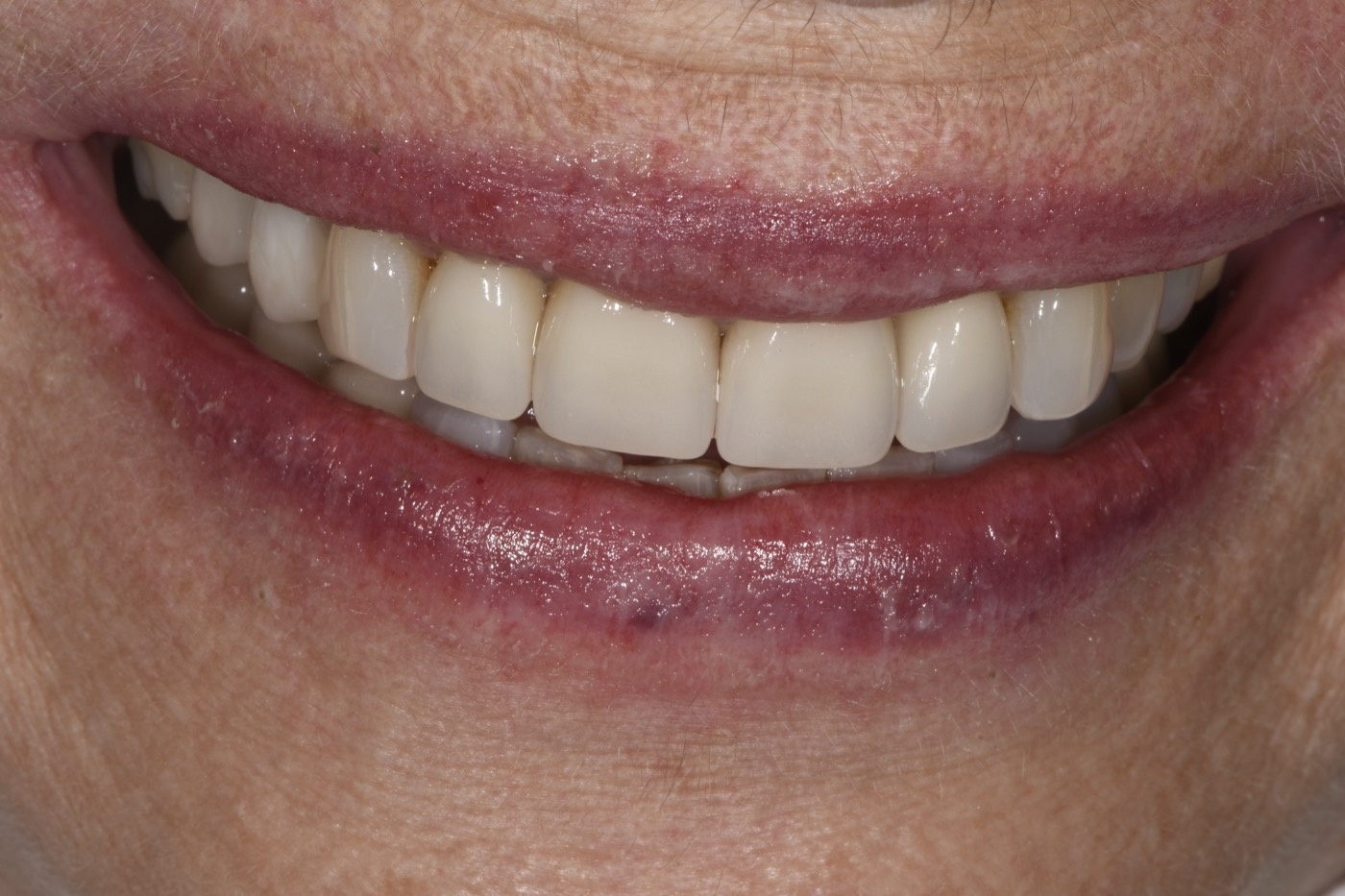Case 14 after photo 1