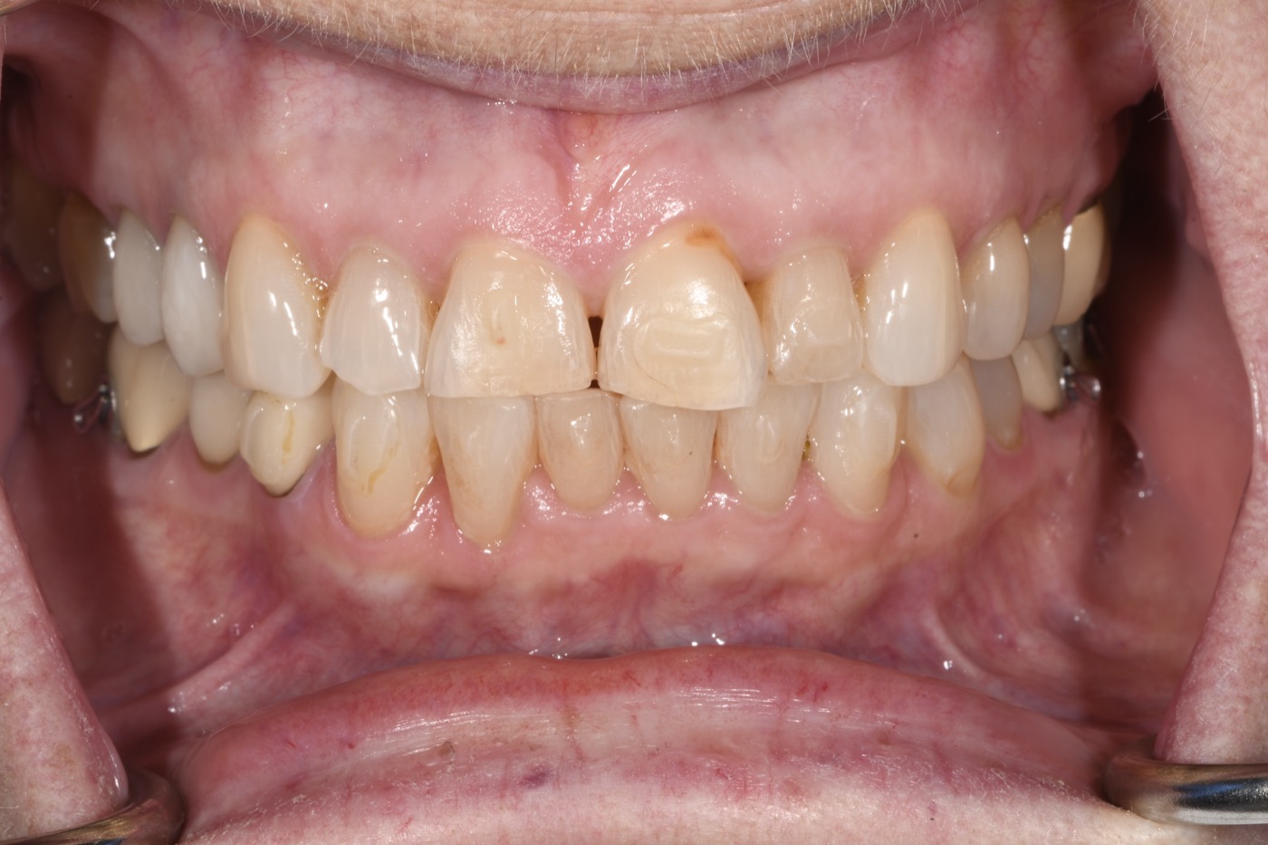 Case 14 before photo 2