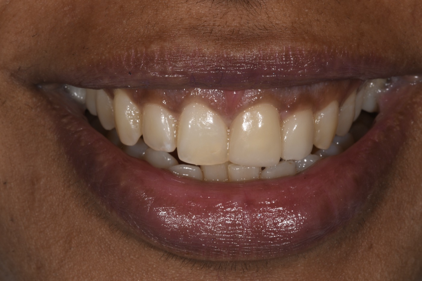 Case 15 after photo 1