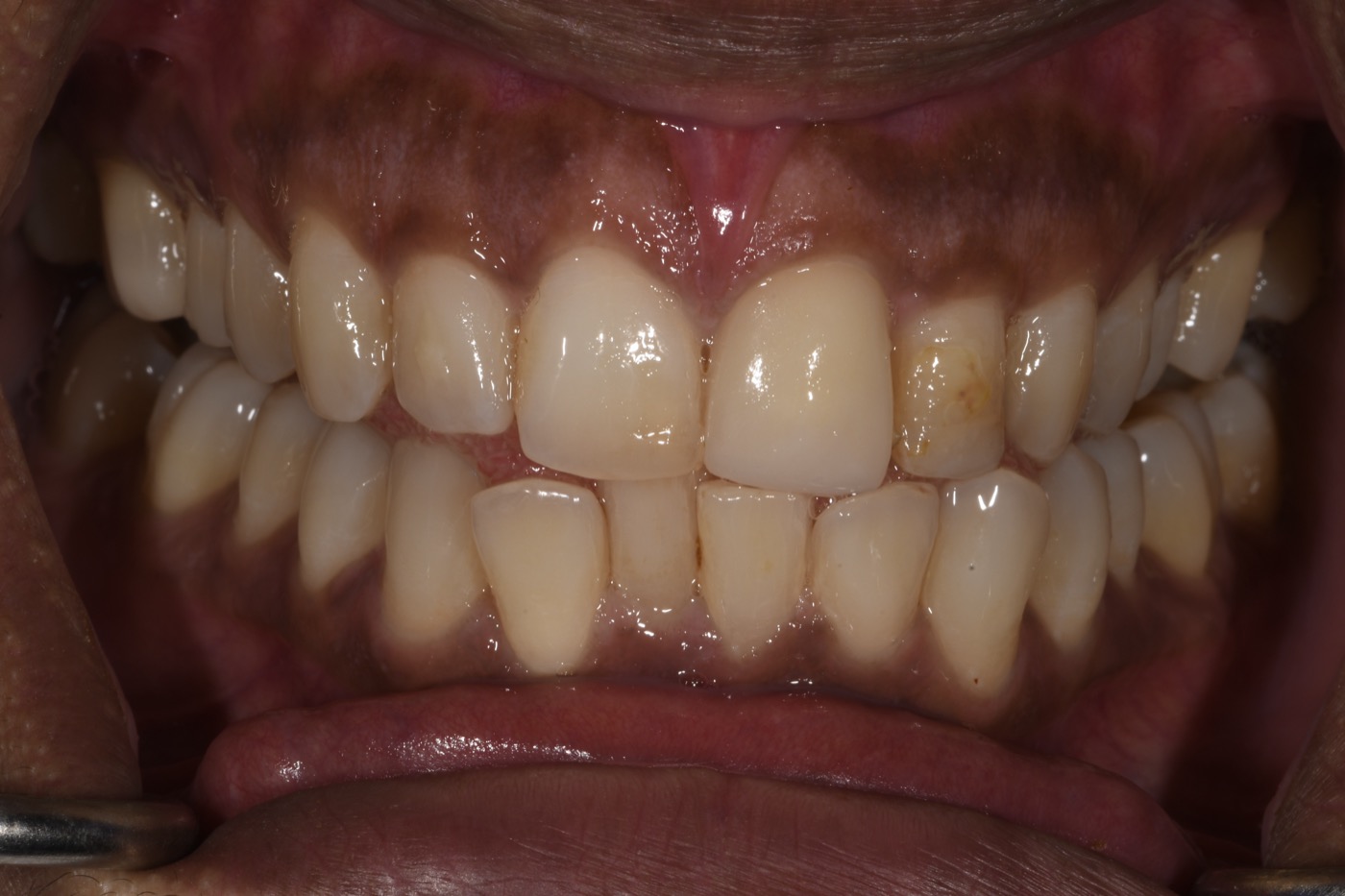 Case 15 before photo 2