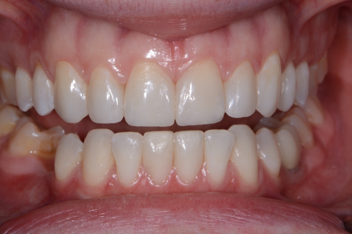 Case 16 after photo 2