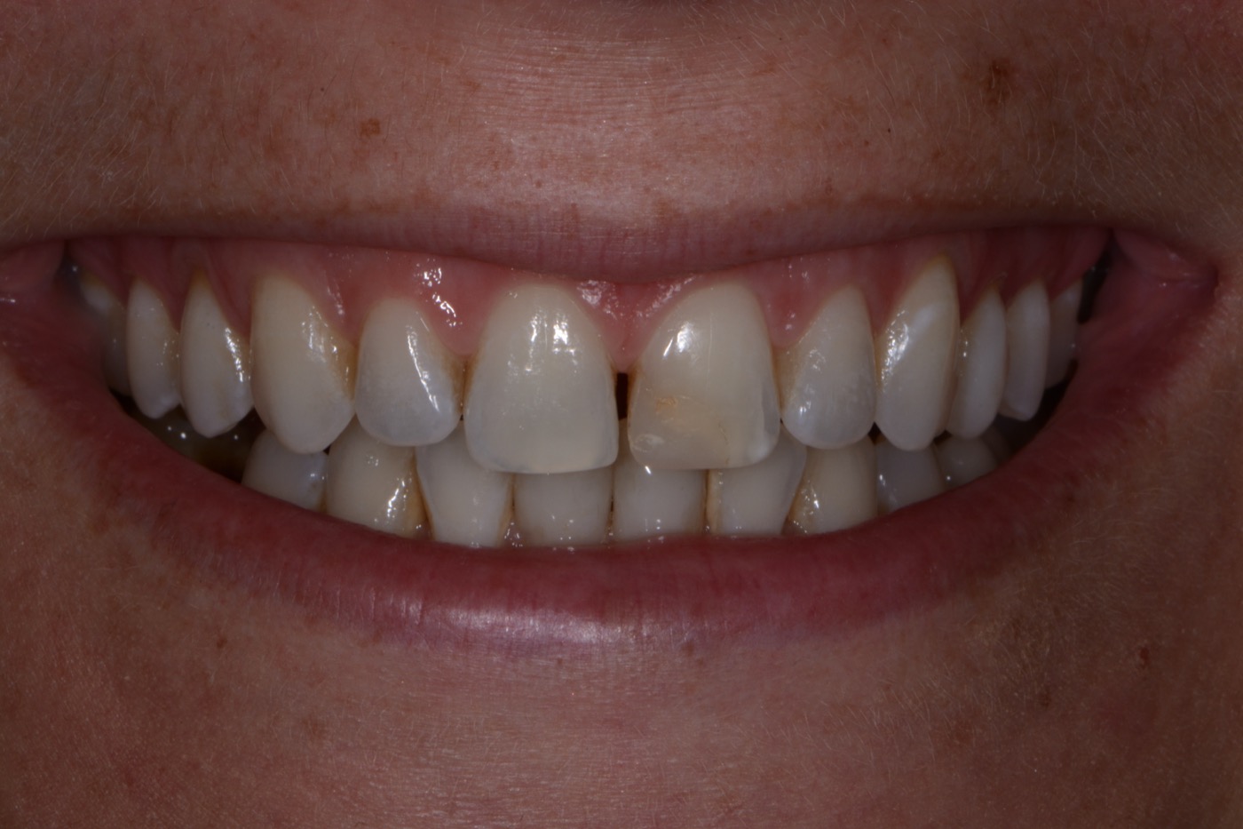 Case 16 before photo 1