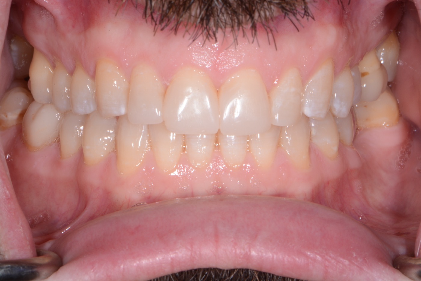 Case 17 after photo 2