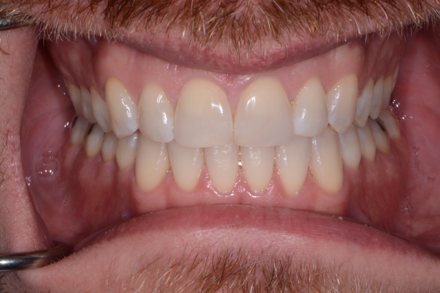 Case 19 after photo 2