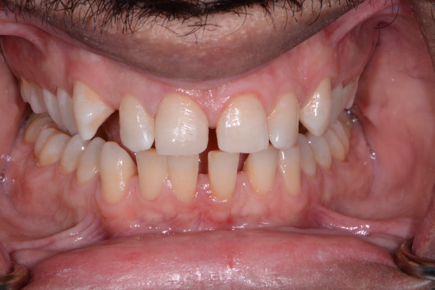 Case 21 after photo 2