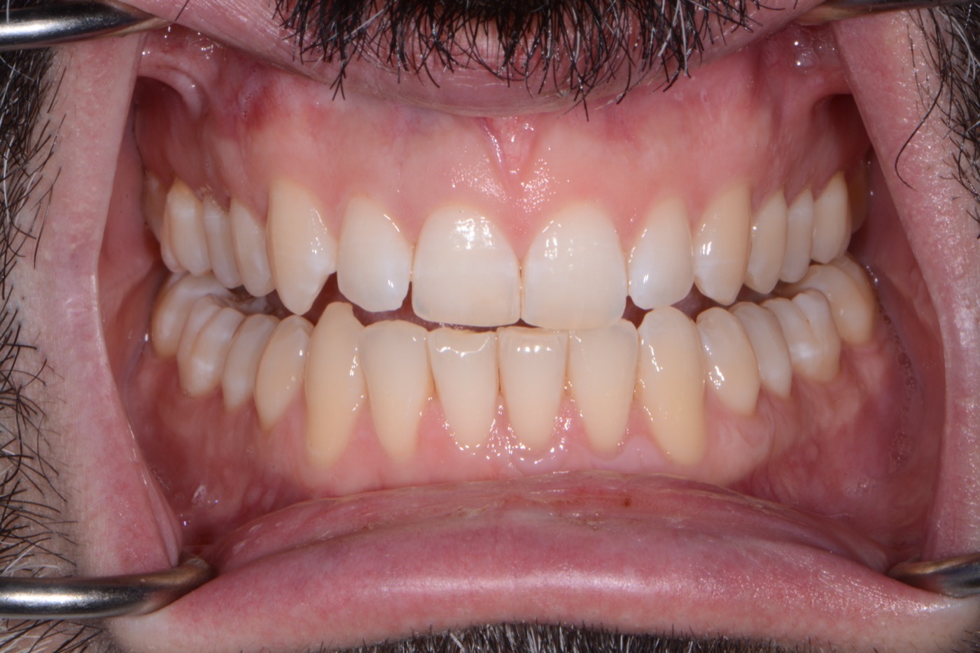 Case 22 after photo 2