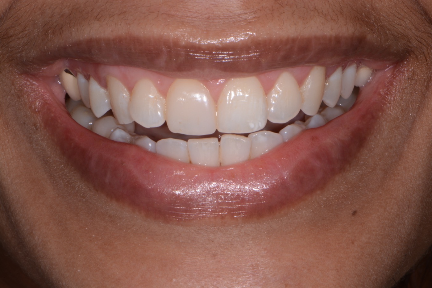 Case 23 after photo 1