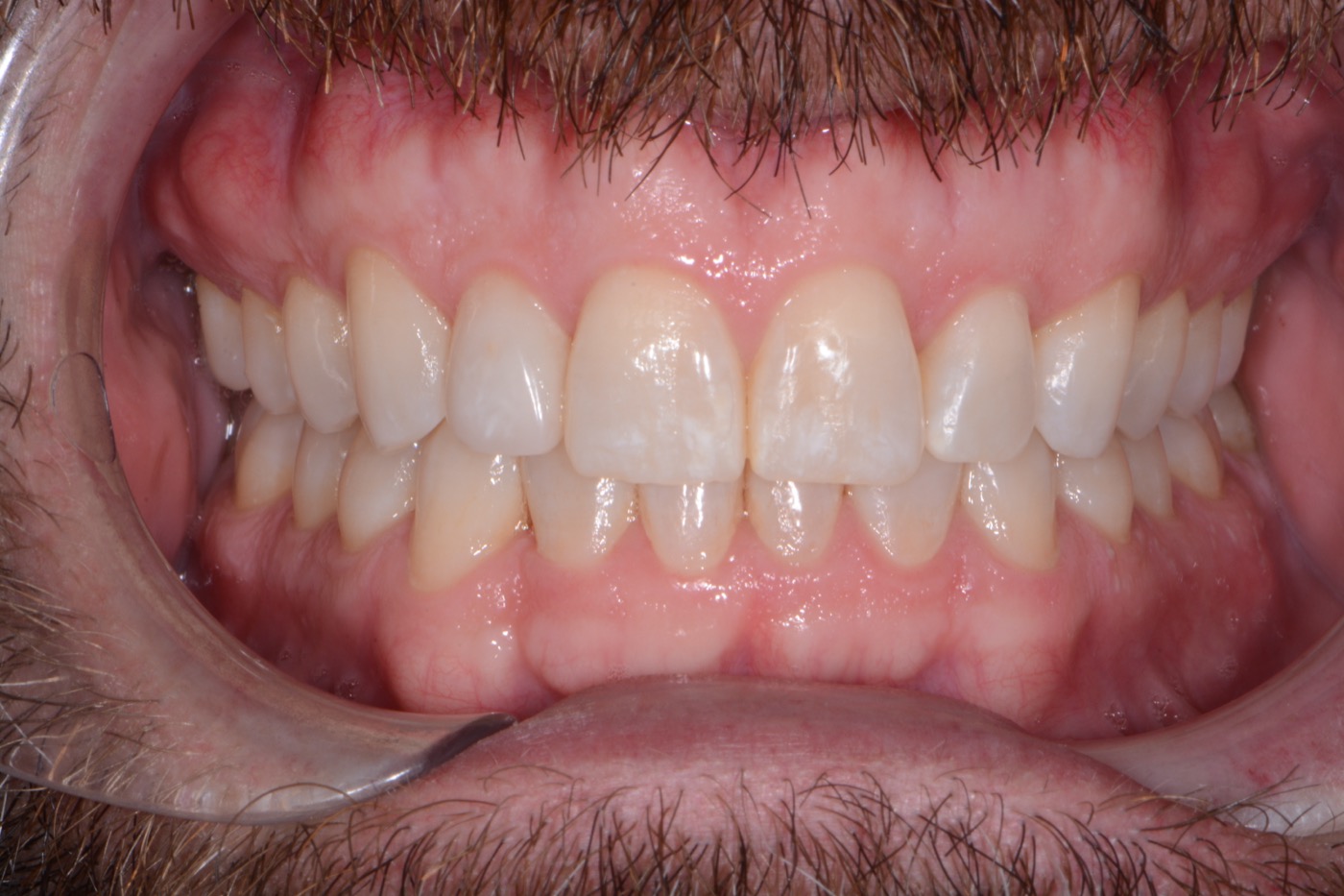 Case 24 after photo 2