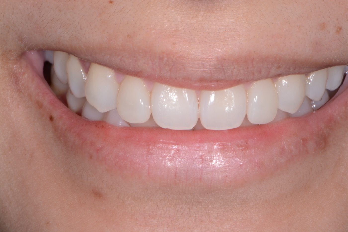Case 25 after photo 1