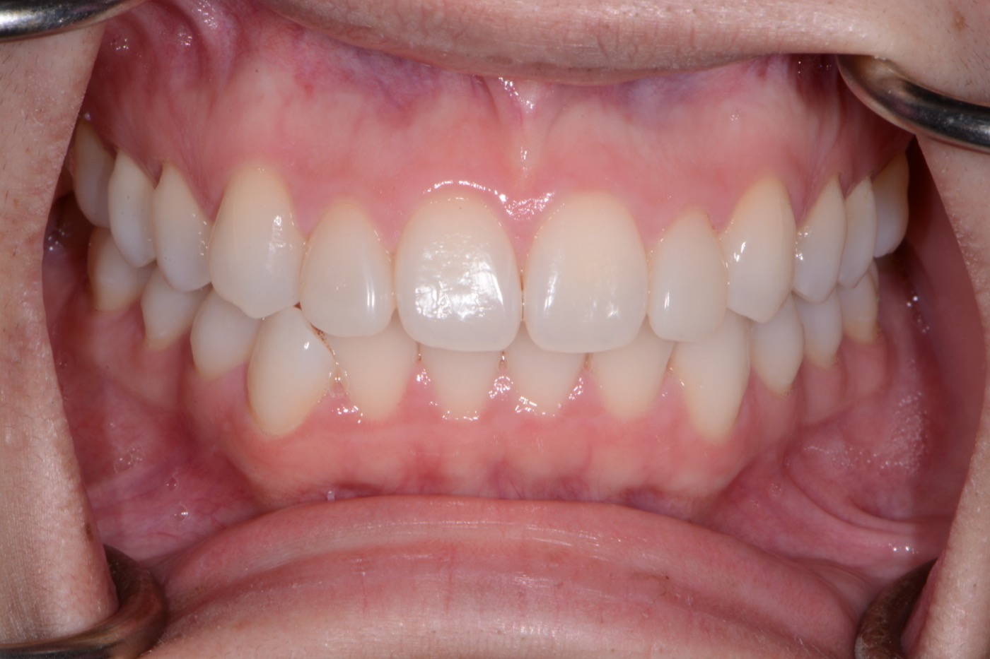 Case 25 after photo 2