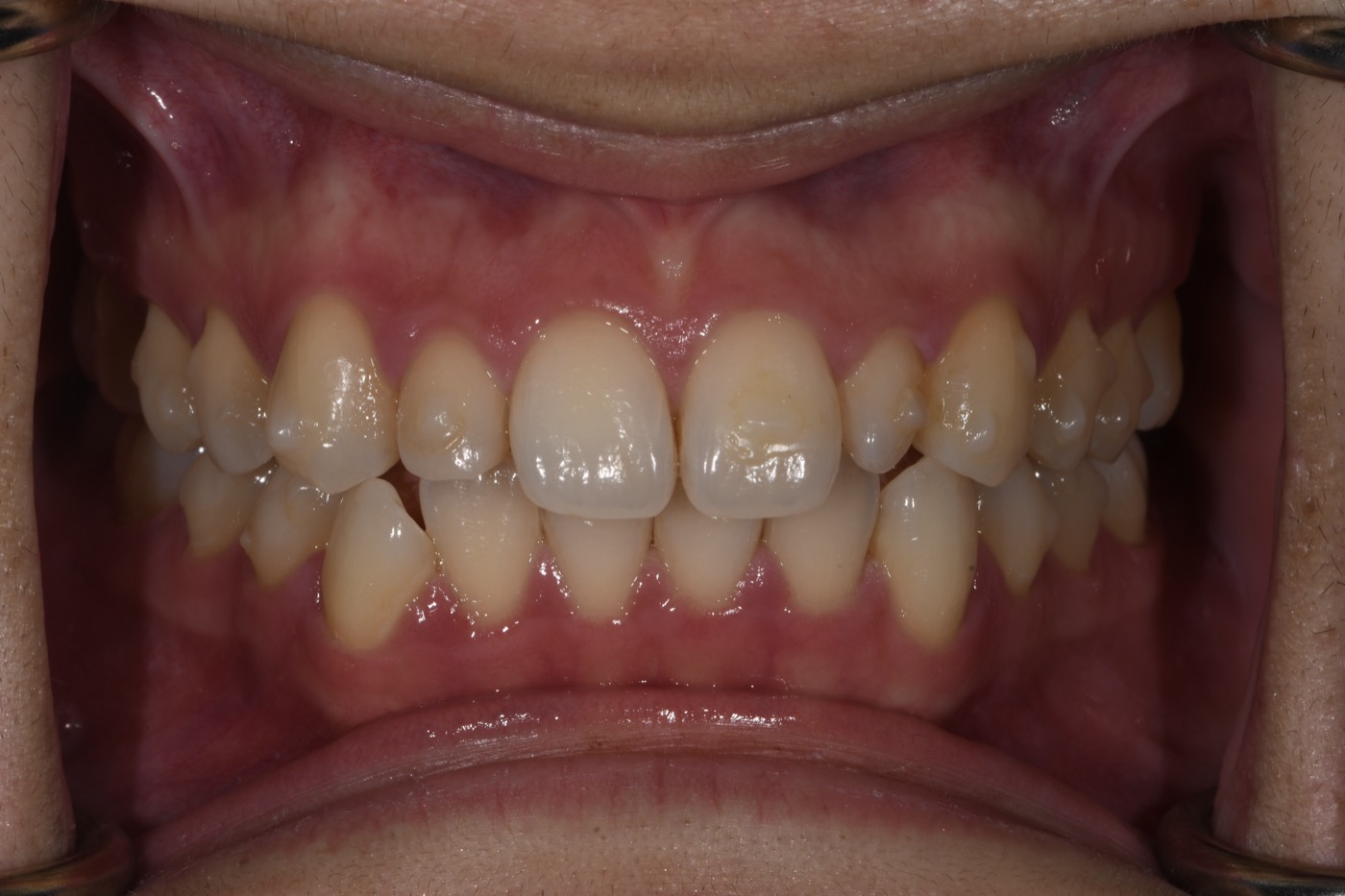 Case 25 before photo 2