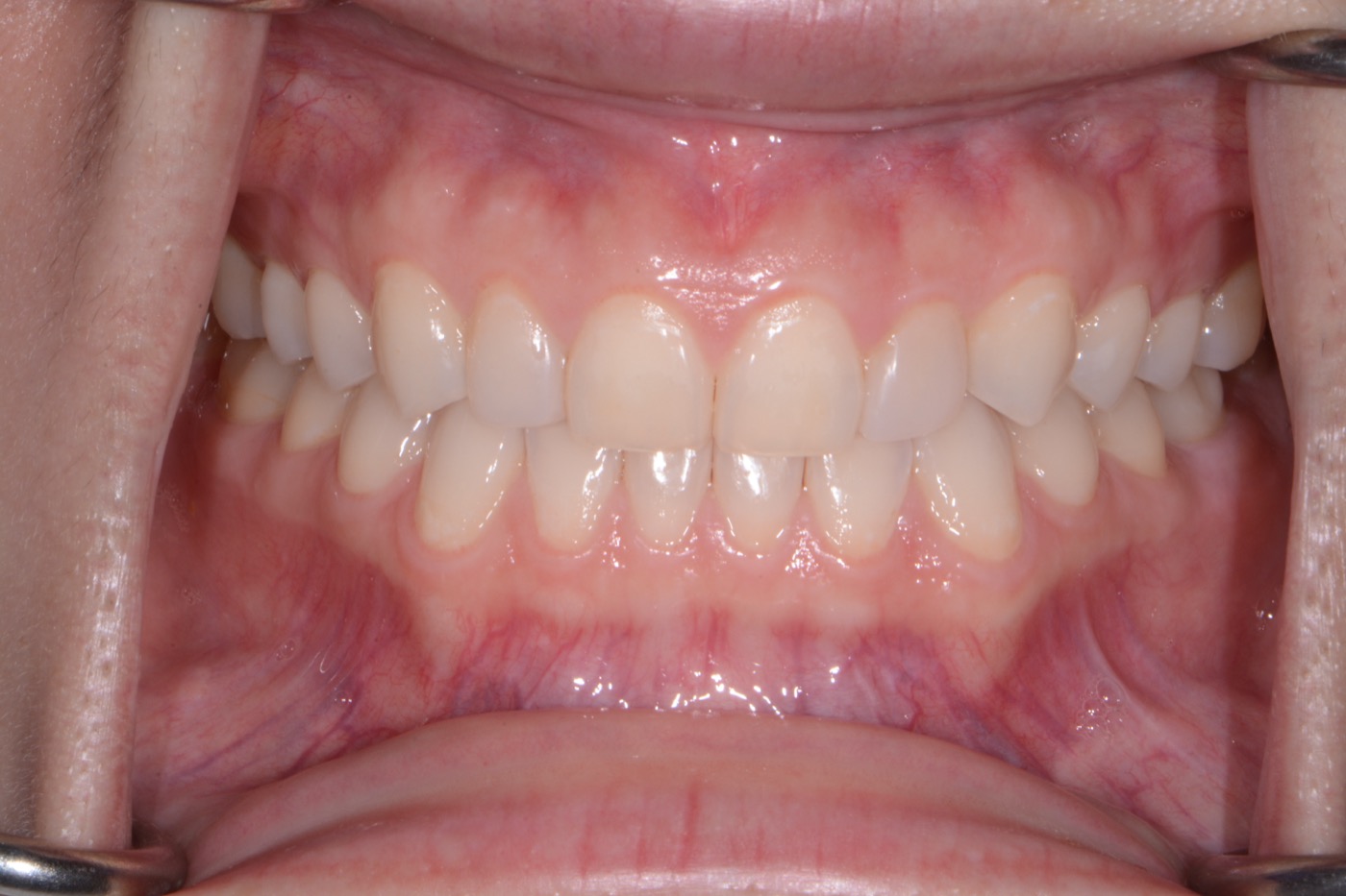 Case 26 after photo 2