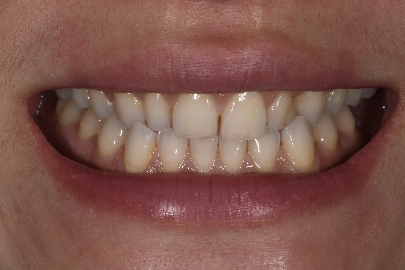 Case 26 before photo 1
