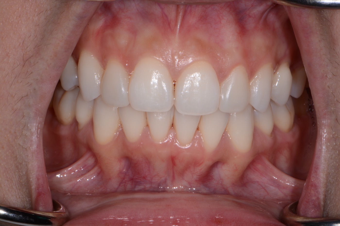 Case 28 after photo 2