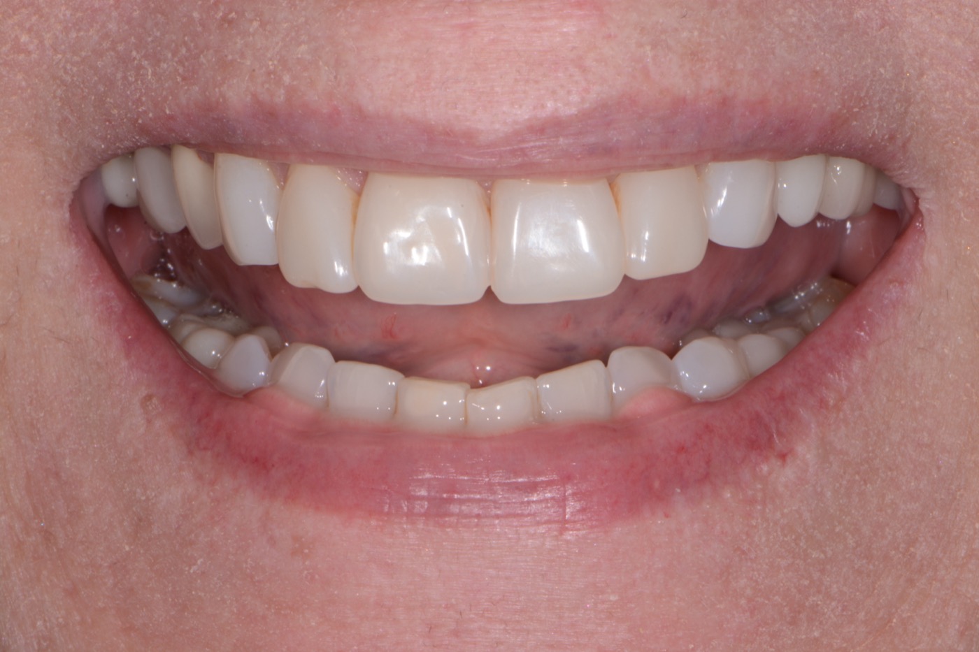 Case 29 after photo 1
