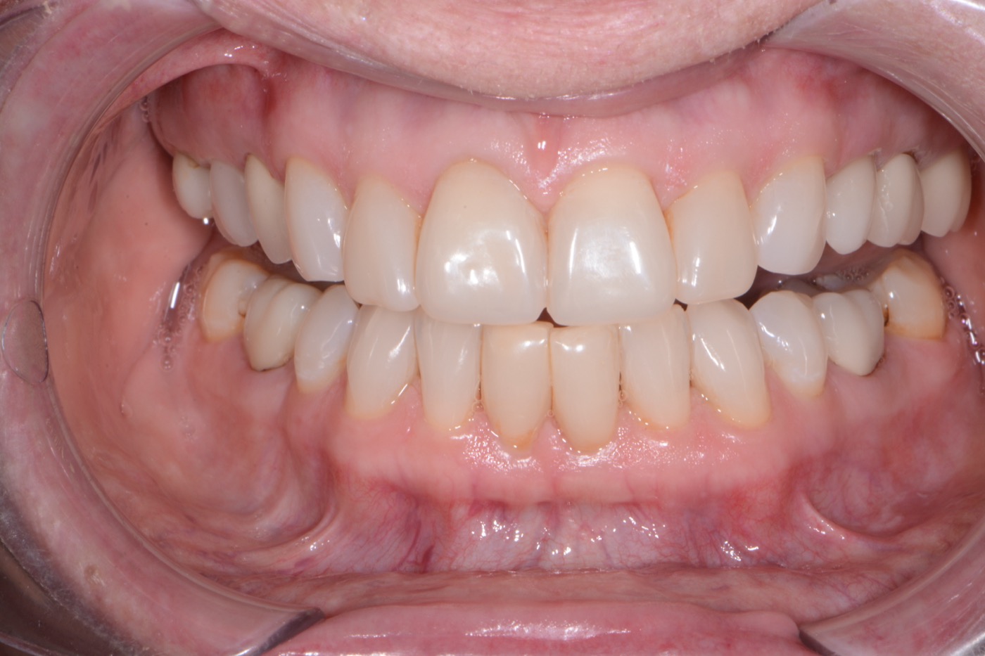 Case 29 after photo 2