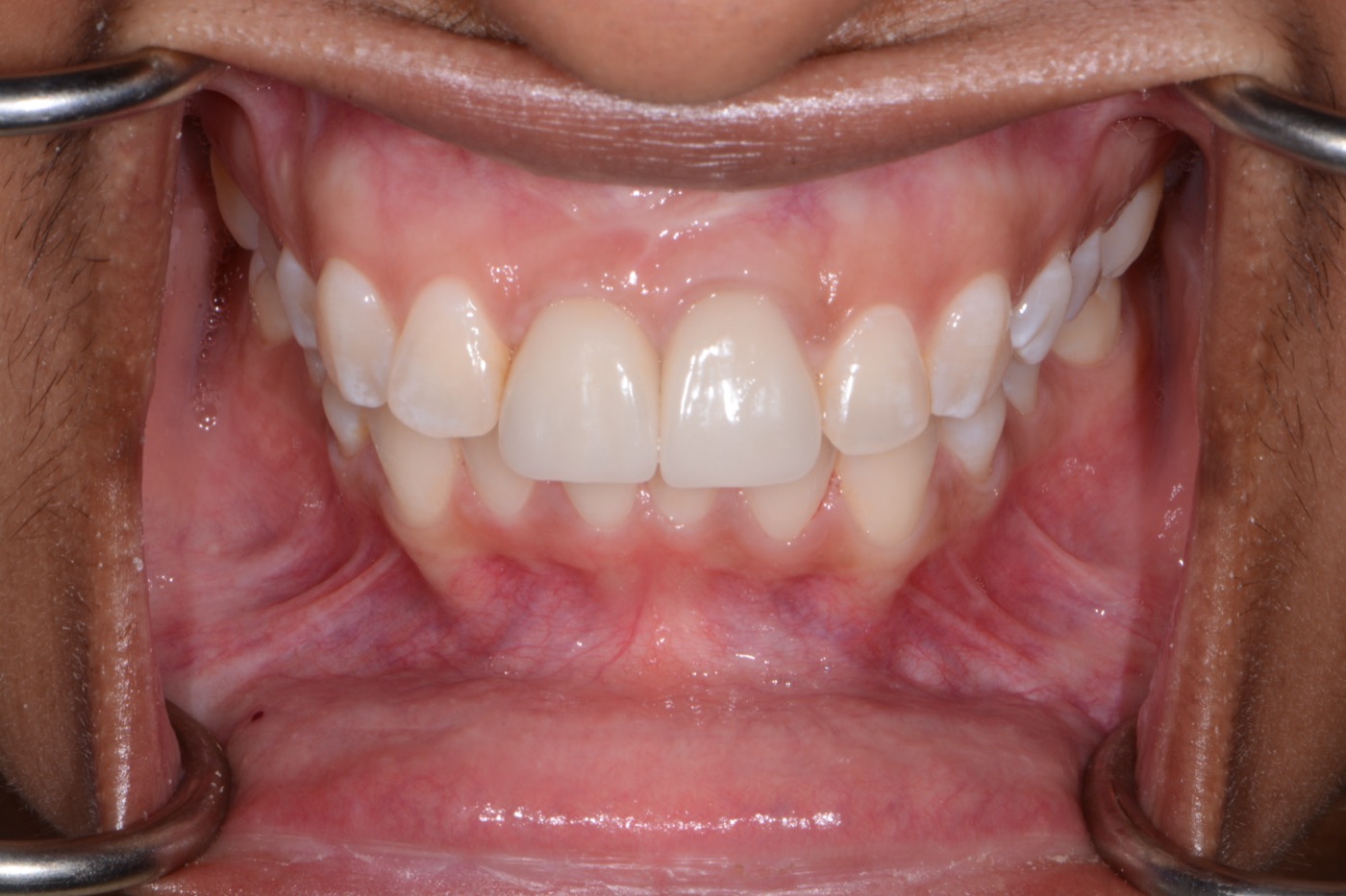 Case 31 after photo 2