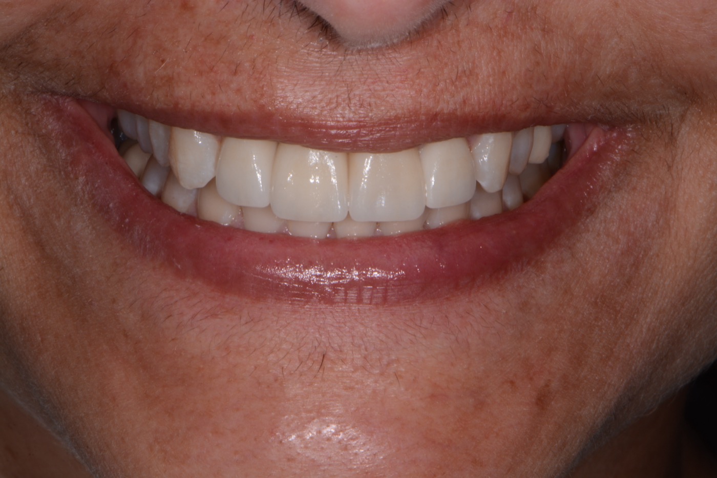 Case 32 after photo 1