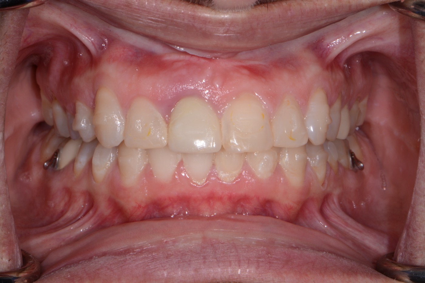 Case 32 before photo 2