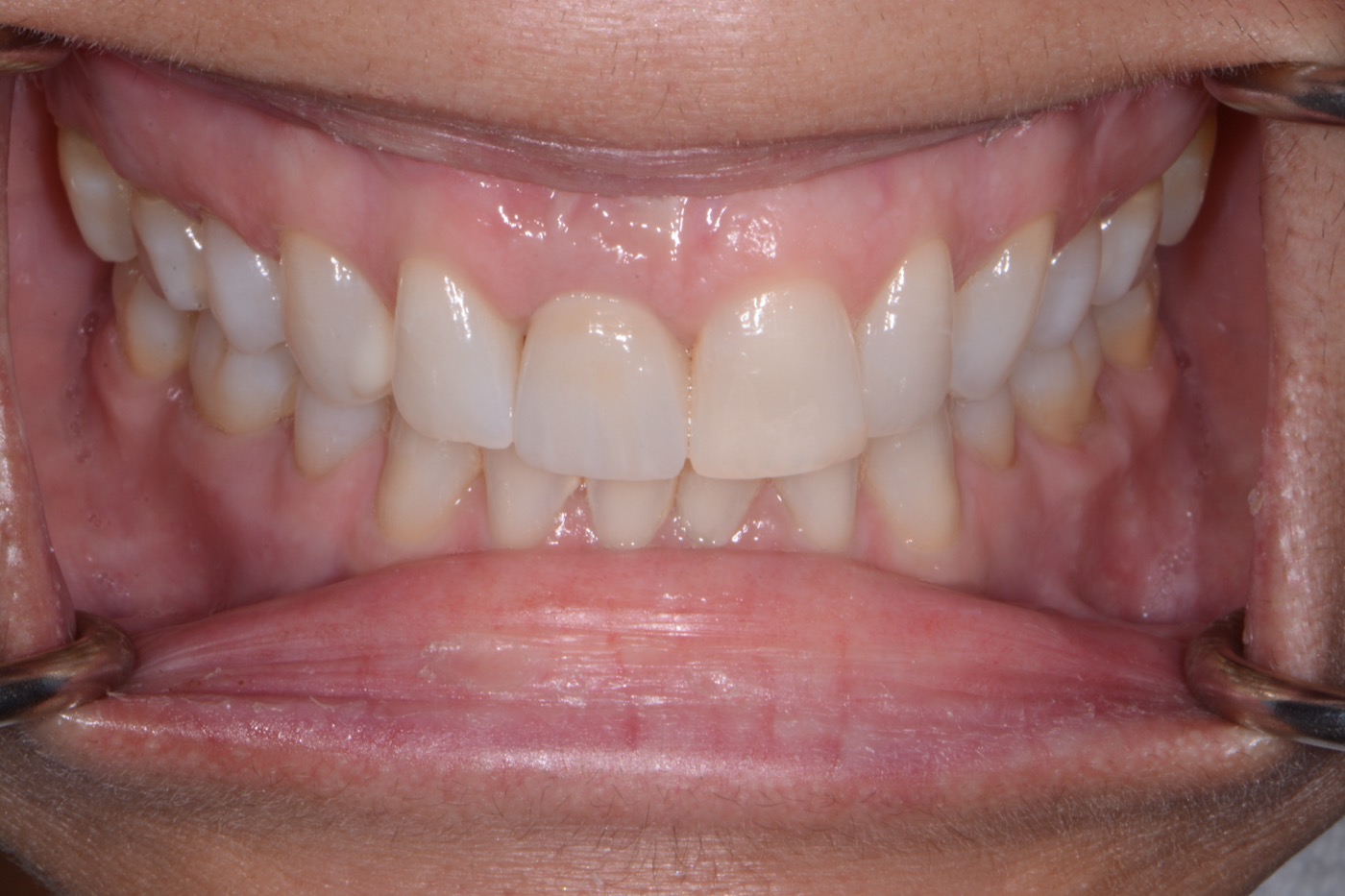 Case 33 after photo 2