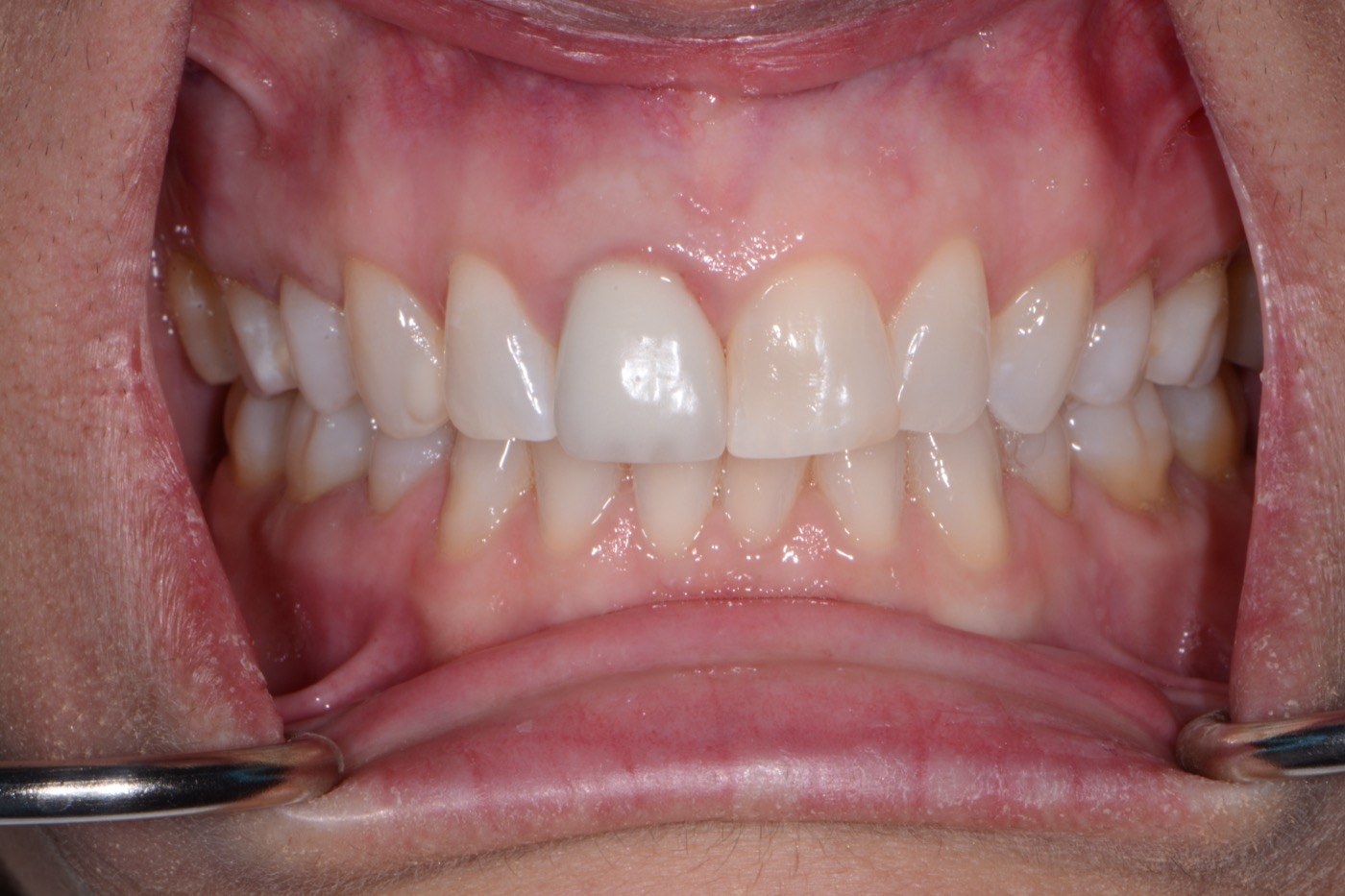 Case 33 before photo 2