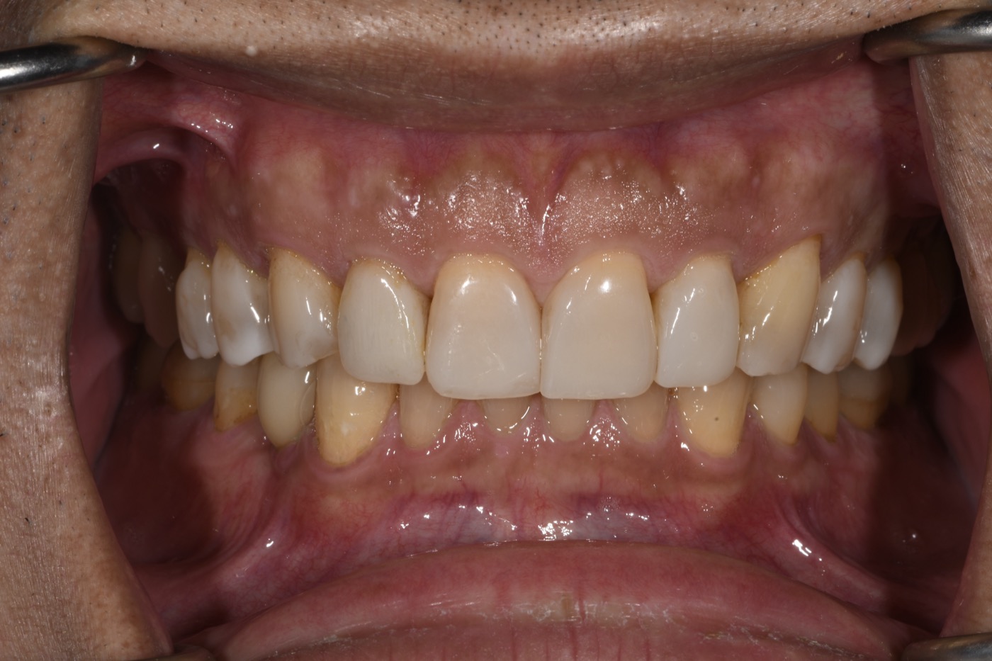 Case 35 after photo 2