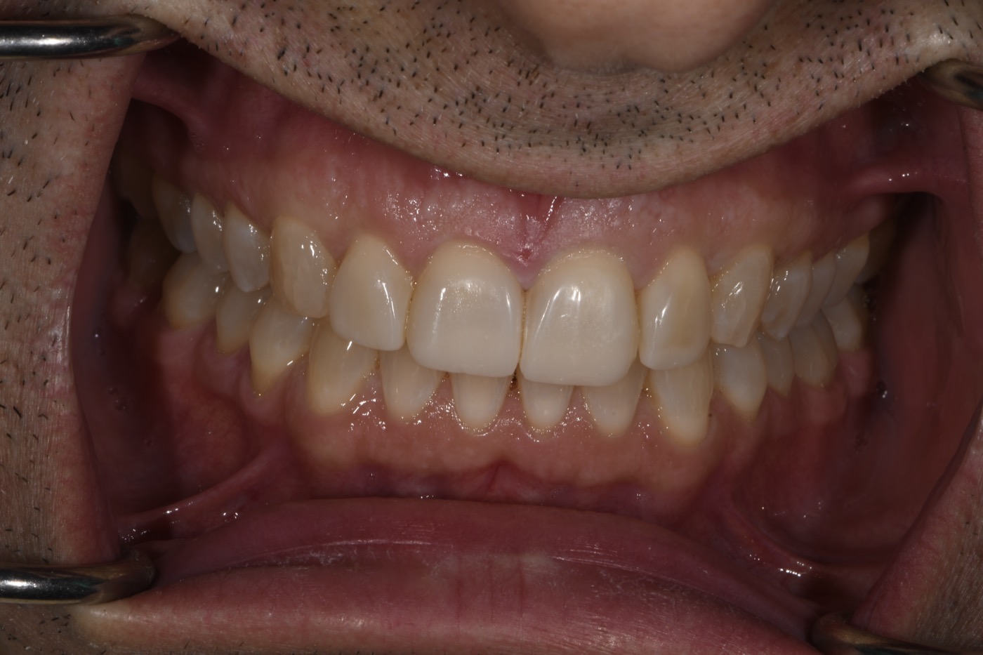 Case 36 after photo 2