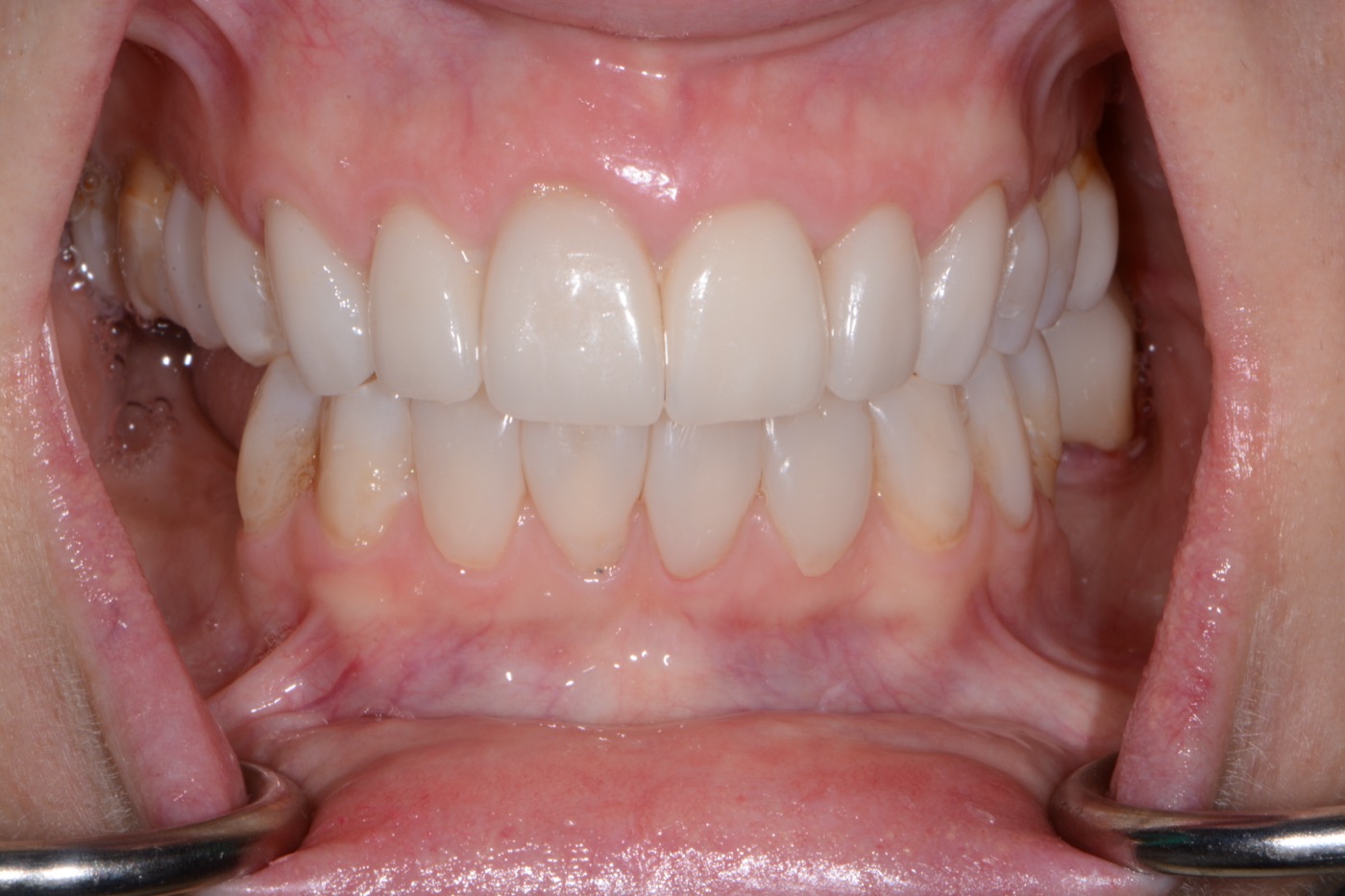 Case 37 after photo 2