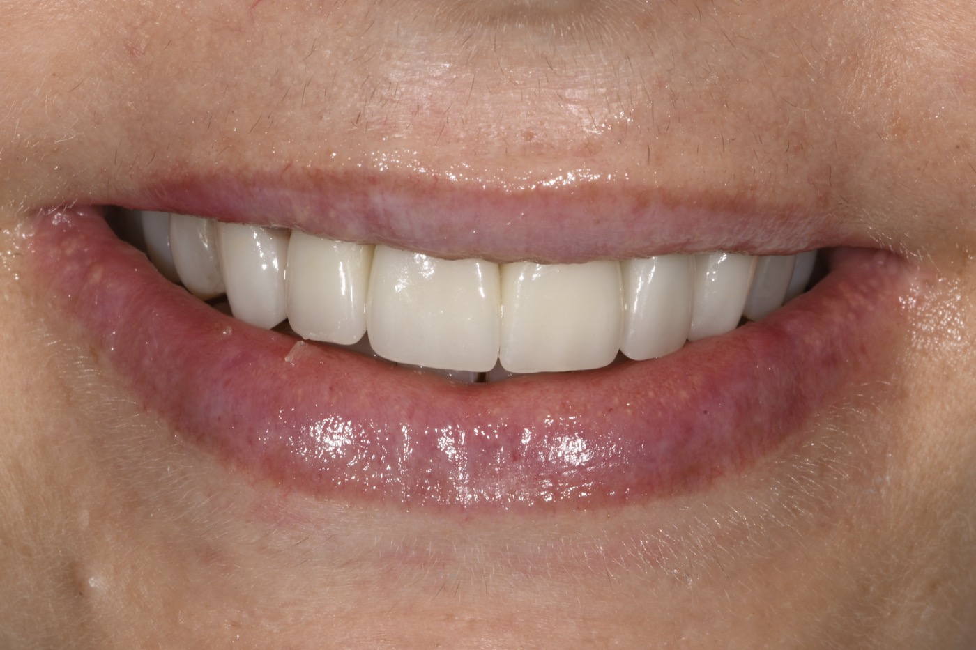 Case 37 after photo 1
