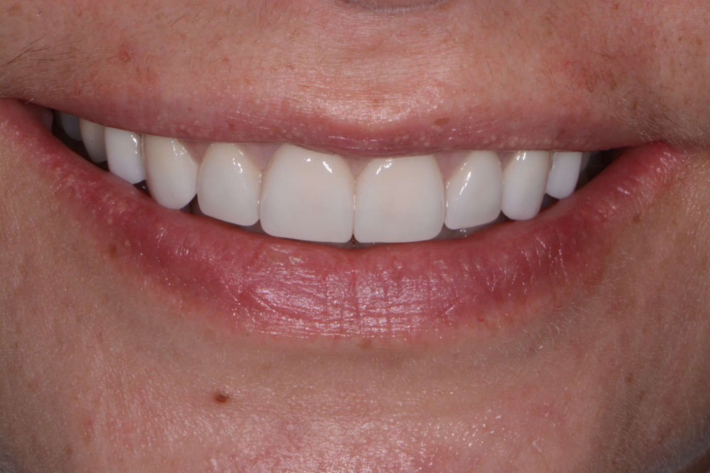 Case 38 after photo 1