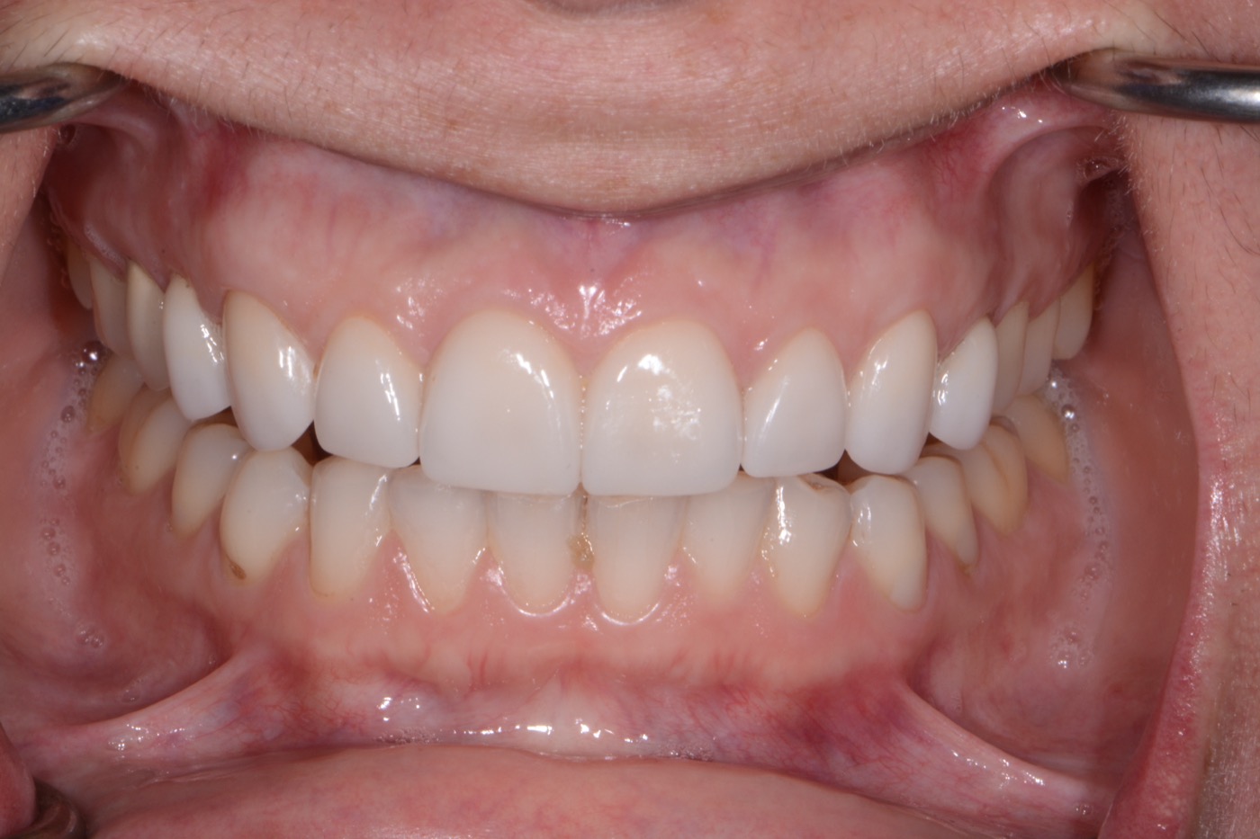 Case 38 after photo 2