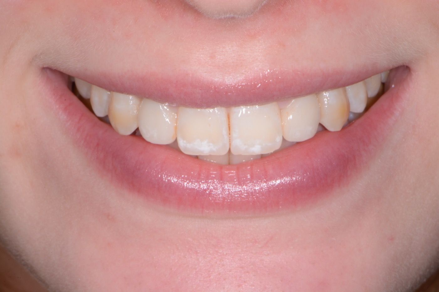 Case 40 after photo 1