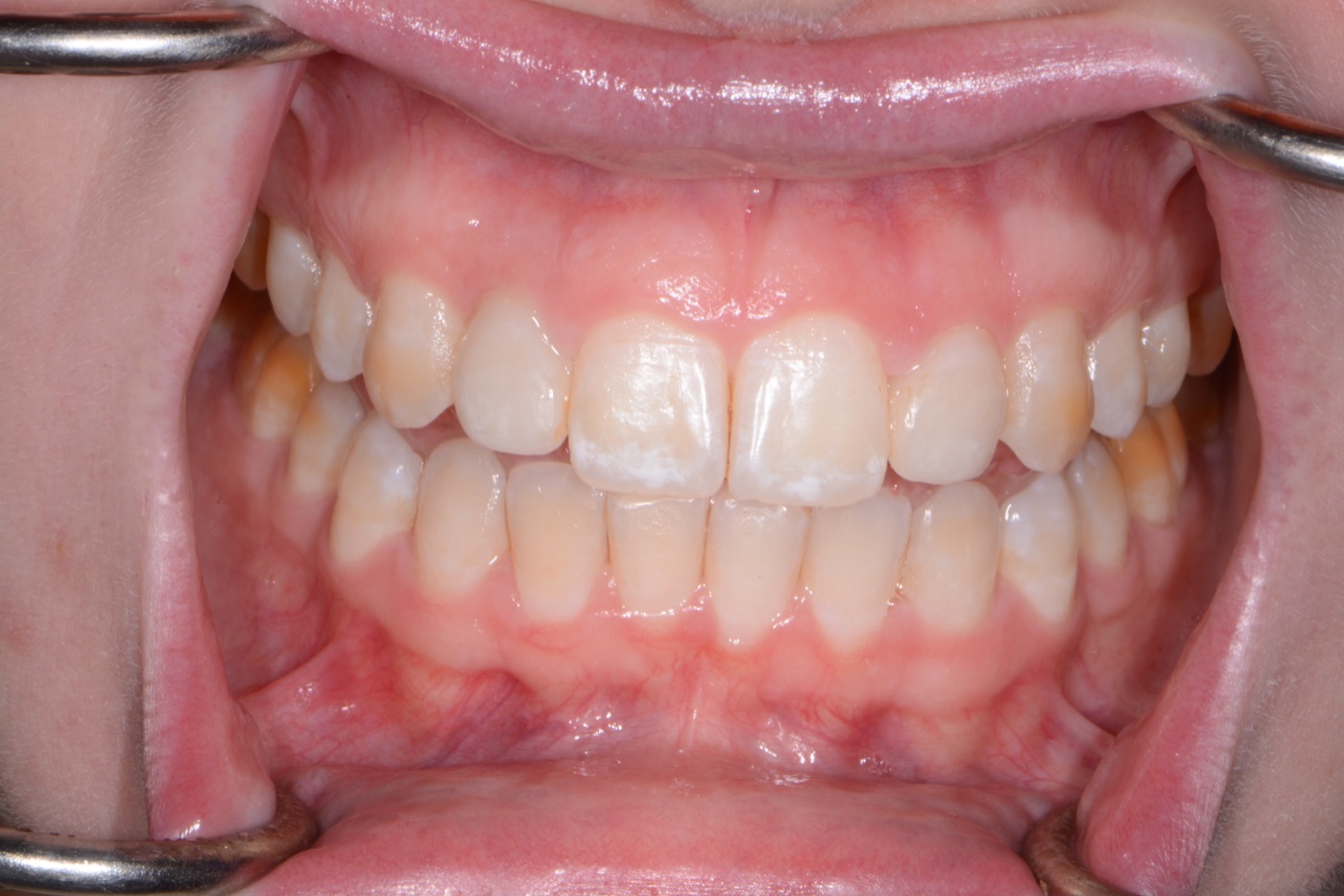 Case 40 after photo 2