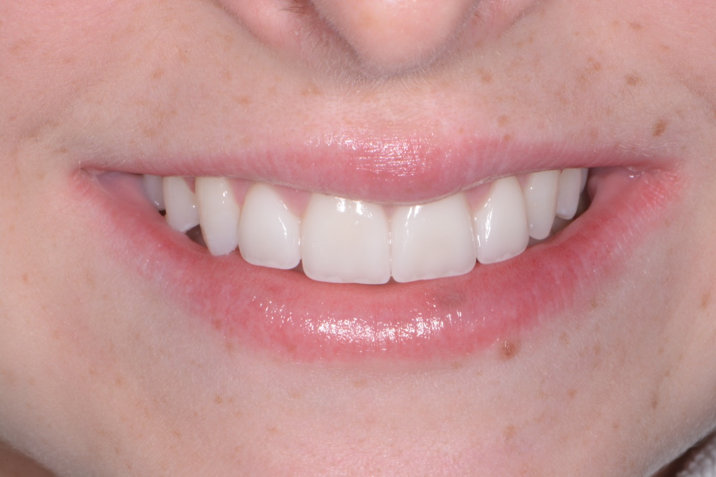Case 41 after photo 1