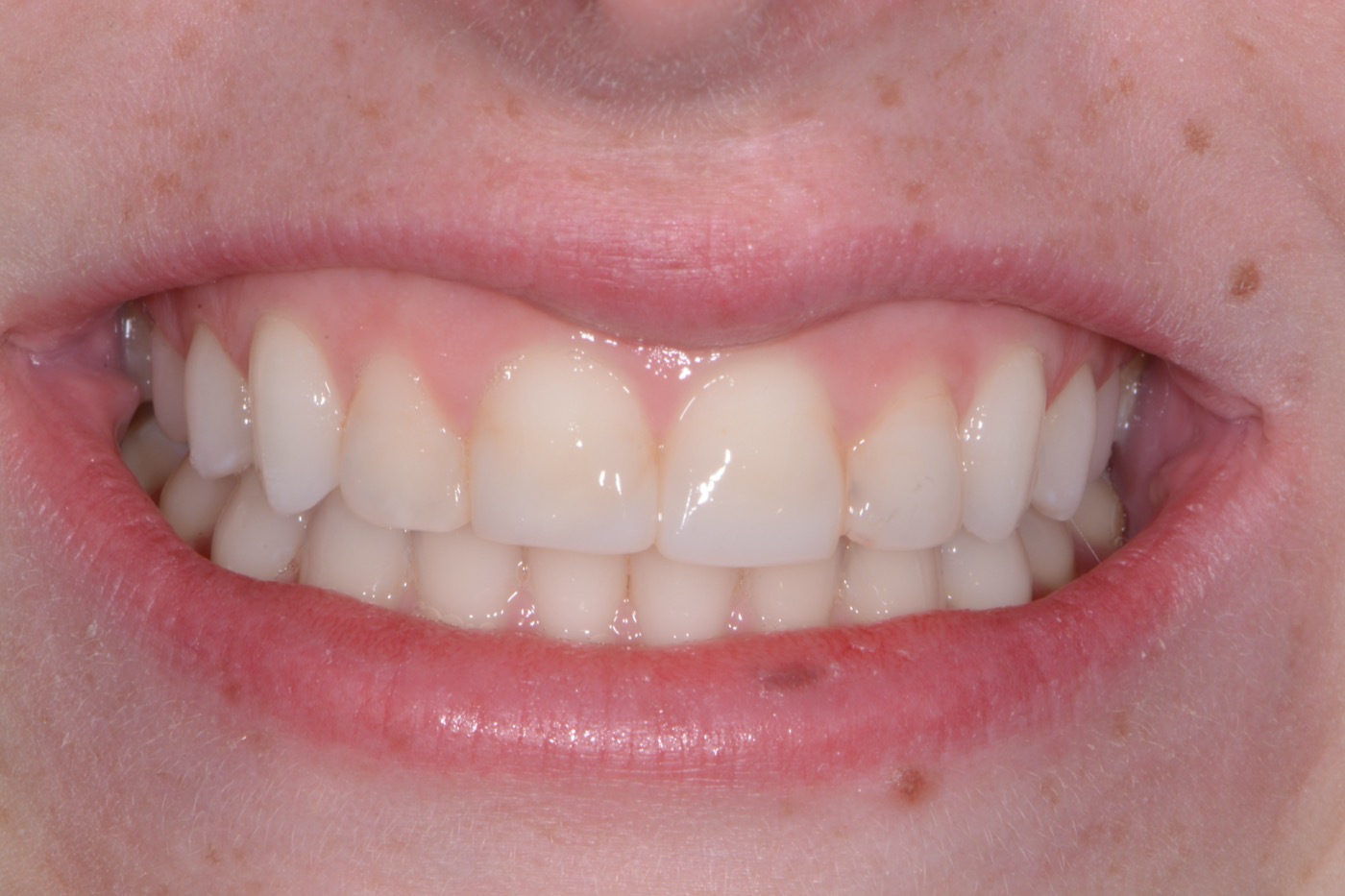 Case 41 before photo 1