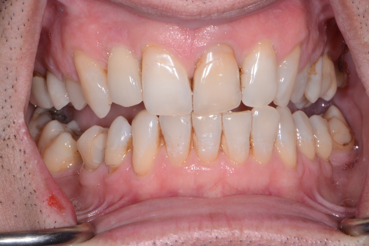 Case 42 after photo 2